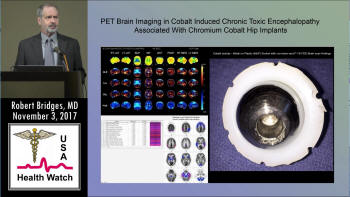 Robert Bridges, MD Presentation on PET Scan Findings in CrCo Hip Implant Patients